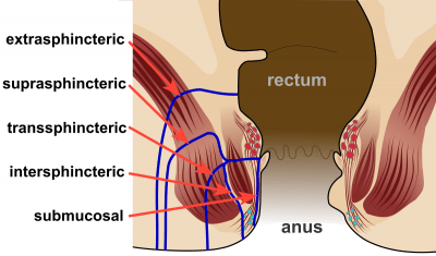 analni absces in fistula