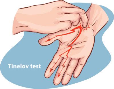 Tinelov test, z mravljinci v rokah in prstih, ponazarja utesnjen karpalni kanal