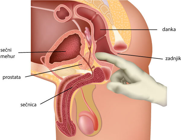 biopsija prostate