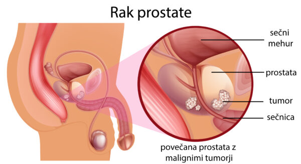 rak prostate, rak na prostati, anatomski prikaz