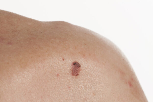 ploščatocelični karcinom kože, kožni rak, spremembe na koži