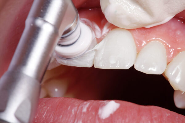 poliranje zob, zobni kamen, zabarvanost zob, zobozdravnik