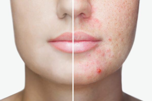 slika obraza mlade ženske, ki je razdeljen na dve polovici. Na desno strani slike so vidne akne na kože, levo pa je neproblematična koža.