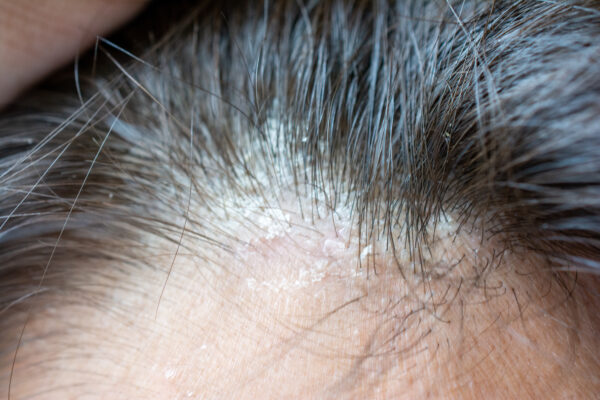 seboroični dermatitis lasišča