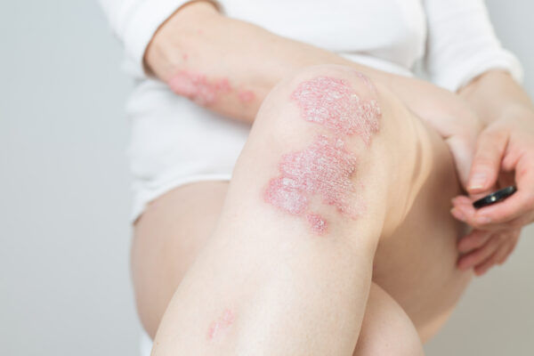 psoriaza ali luskavica na kolenu mlade ženske