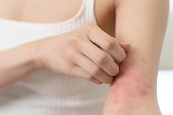 Ekcem, atopijski dermatitis v komolčni kotanji mlade ženske.